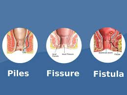 Piles, fissure, fistula
