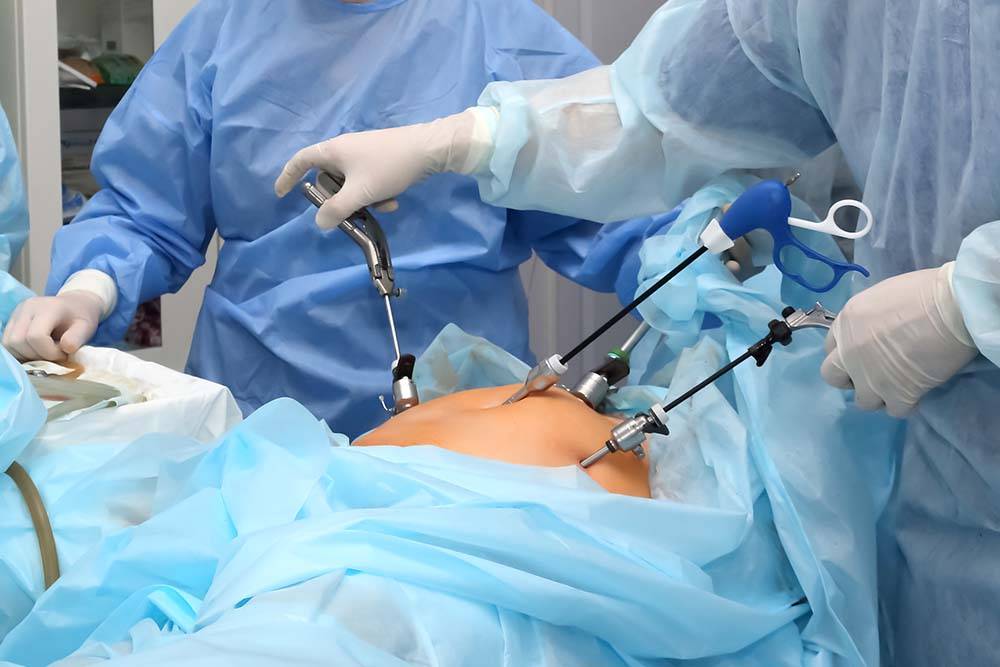 Laparoscopic surgery