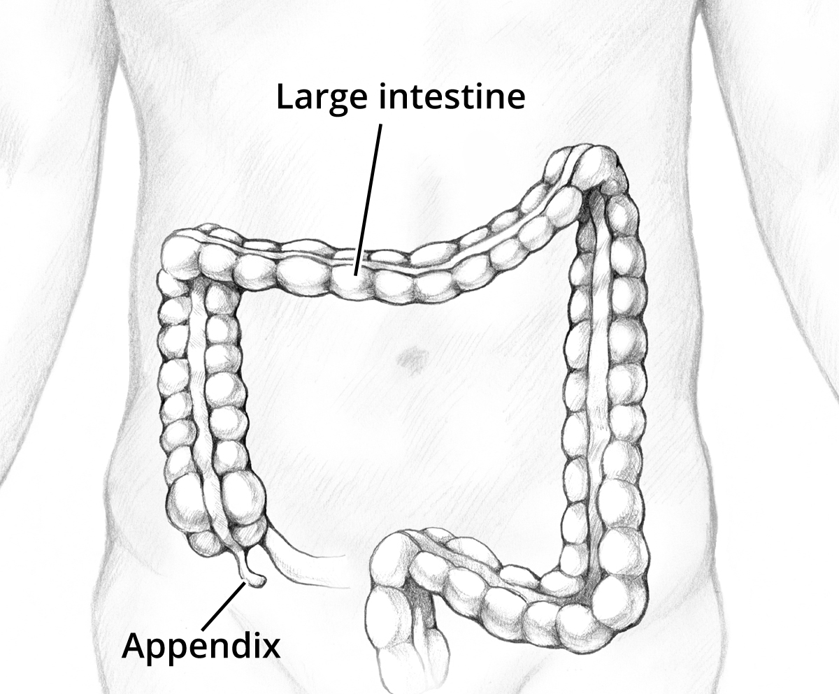 Appendicitis (Appendectomy)